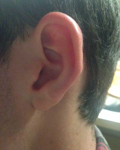 Ear Keloid Treatment with Cryotherapy - Durable Outcome Ear Keloid Treatment with Cryotherapy - Durable Outcome
