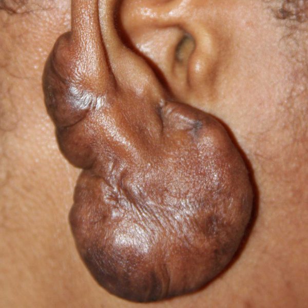 Semi-Massive Ear Keloid