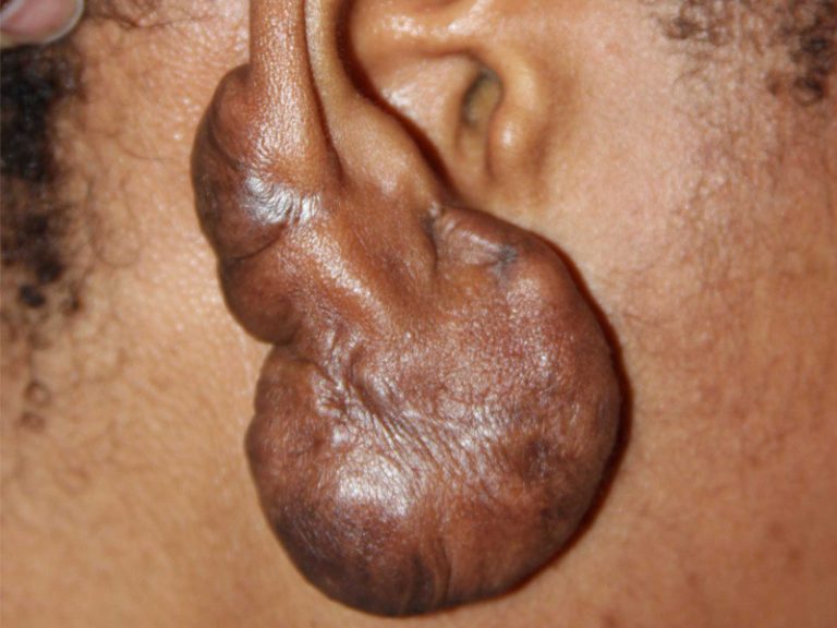 Very Large Ear Keloid Very Large Ear Keloid - Failure of Surgery
