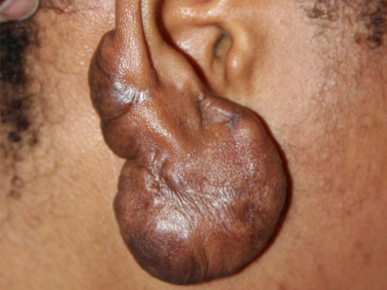 Very Large Ear Keloid - Failure of Surgery