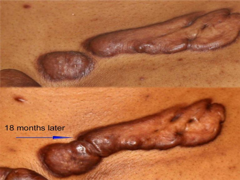 Progression of Chest Keloids over time.