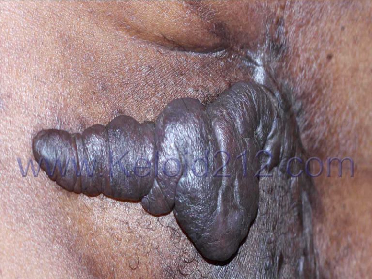 Large Tumoral Pubic Keloid Treated with Cryotherapy 