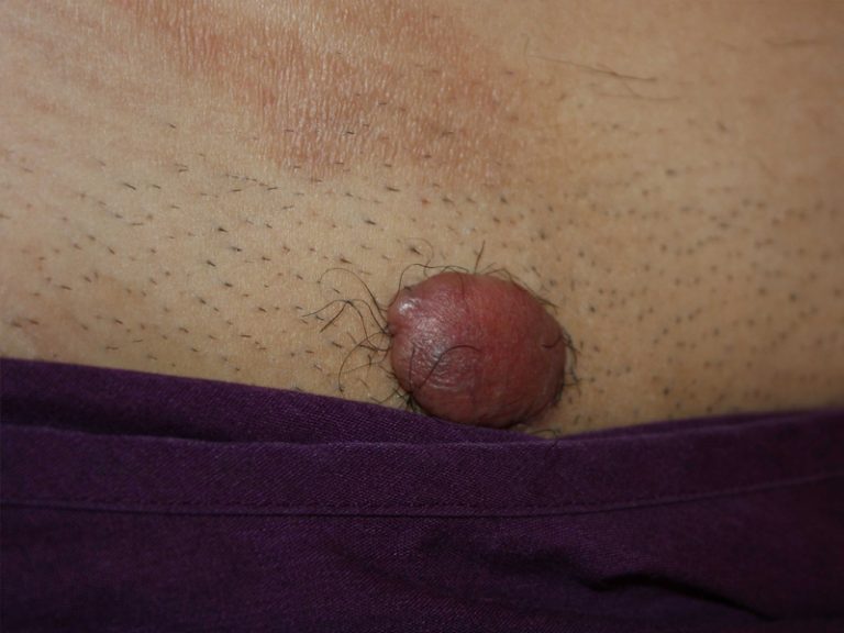 Tumoral Pubic Keloid