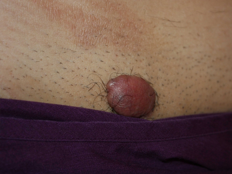 Tumoral Pubic Keloid Solitary Tumoral Pubic Keloid