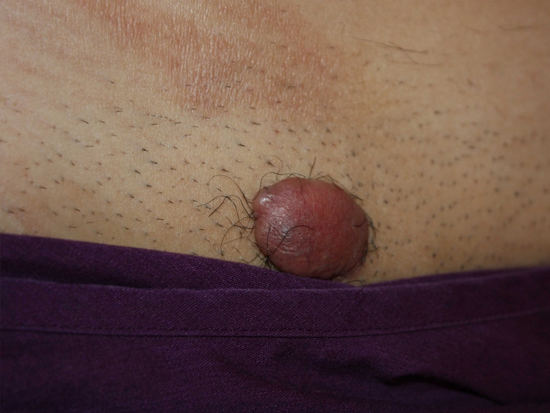 Solitary Tumoral Pubic Keloid