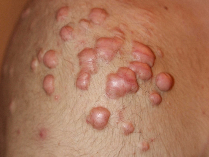 Nodular Shoulder Keloids
