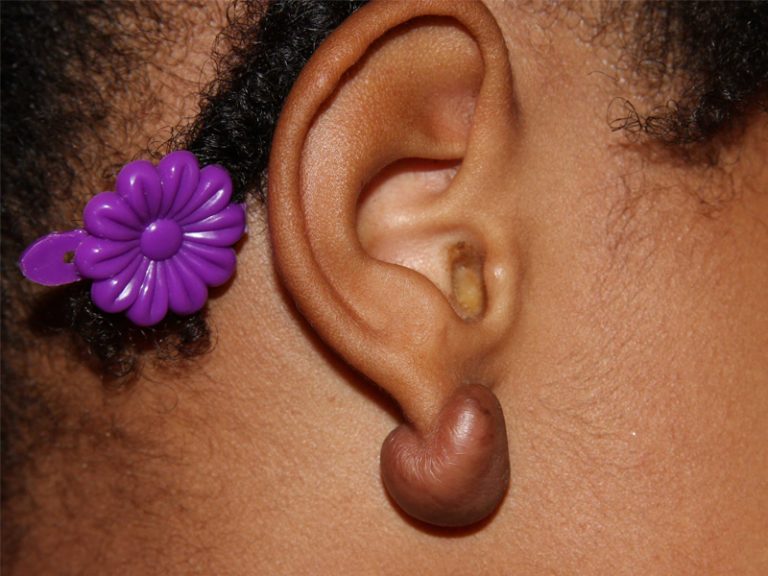 Earlobe Keloids in Children