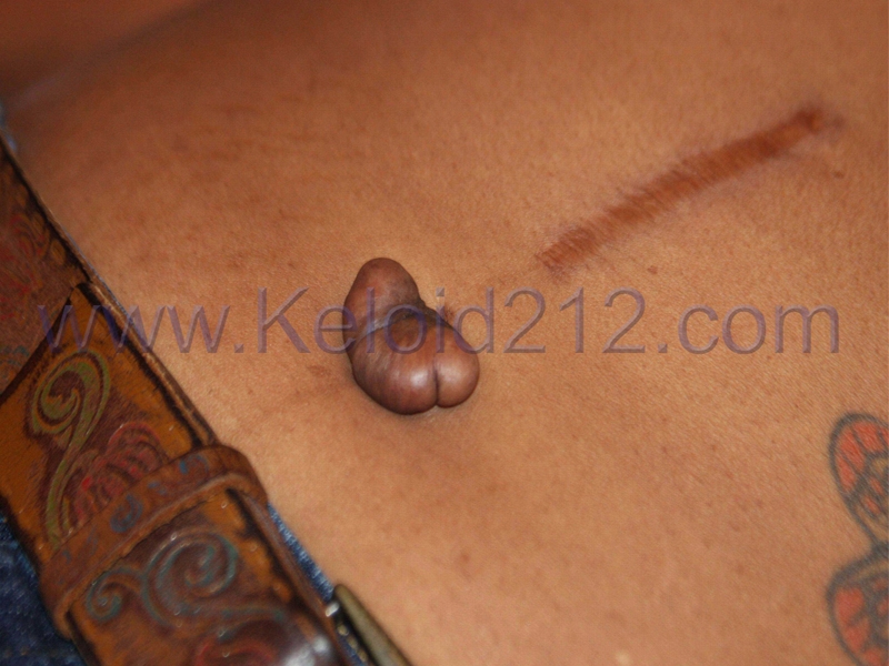 keloid formation treatment