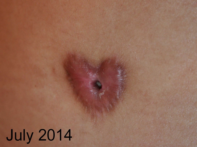 Circular Umbilical Keloid