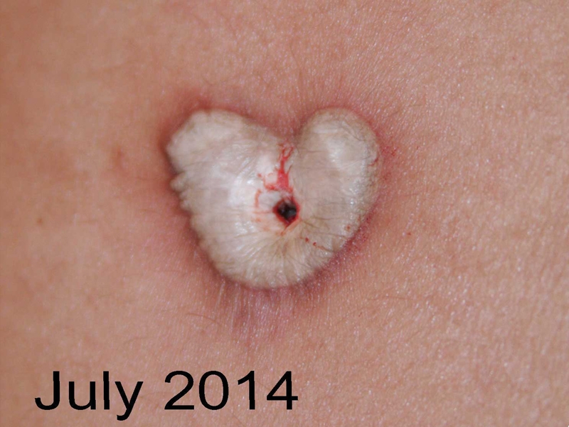 Umbilical Keloid treated with cryotherapy