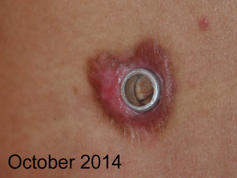 Umbilical Keloid treated with cryotherapy and dilatation device Umbilical Keloid treated with cryotherapy and dilatation device