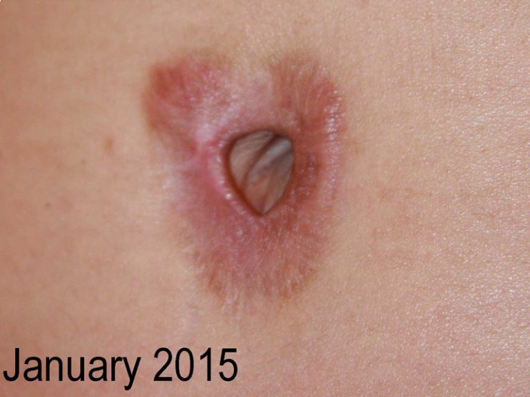 Umbilical Keloid - Treatment Results with cryotherapy Umbilical Keloid - Treatment Results with cryotherapy