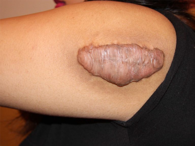 upper arm keloid