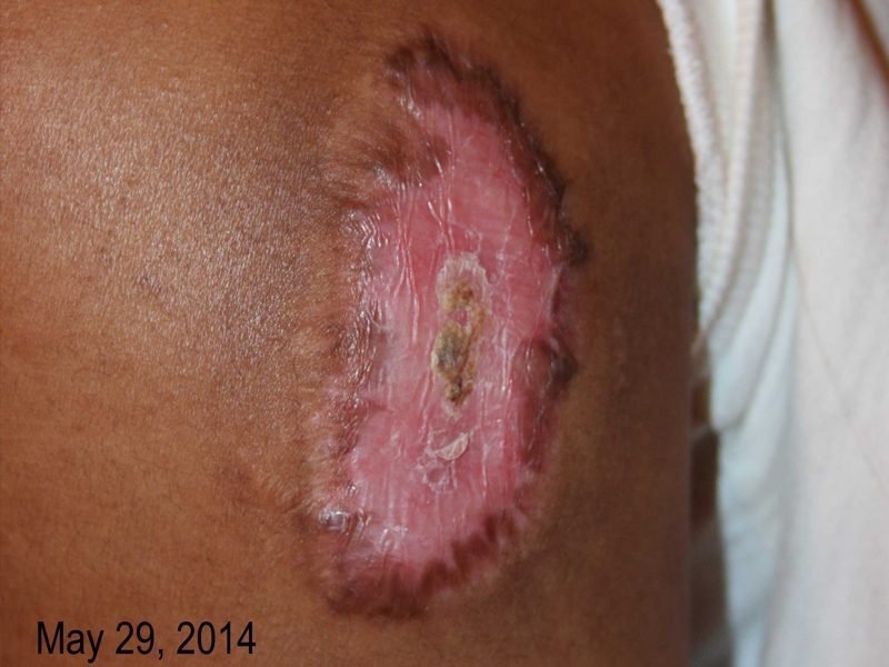 Upper Arm Keloid