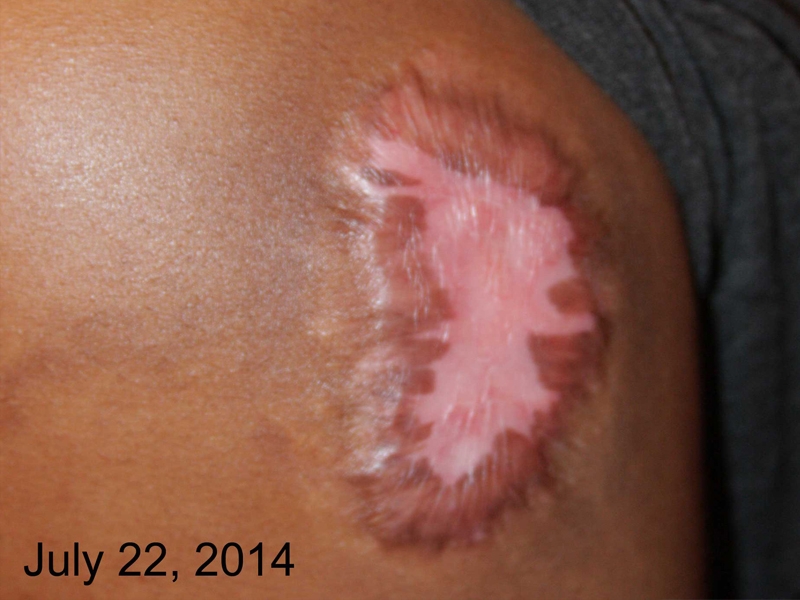 Upper Arm Keloid