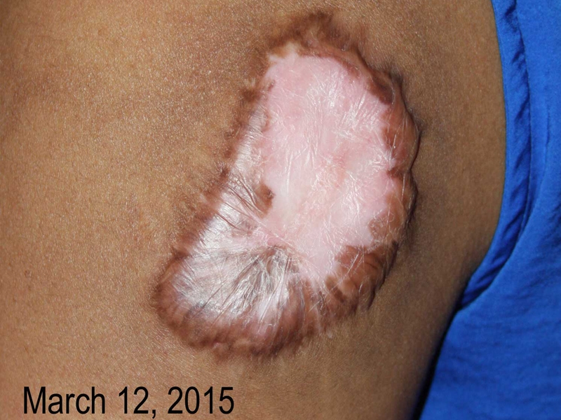 Upper Arm Keloid