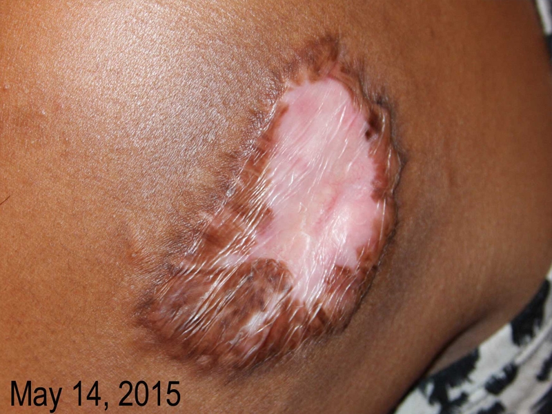 Upper Arm Keloid