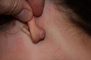 Earlobe Keloid in Children