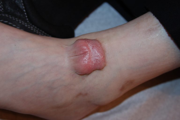 Pediatric Foot Keloid Keloids in Children