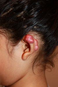 Otoplasty Ear Keloids in Children