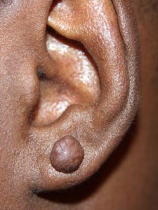 Nodular- Early Stage Earlobe Keloid