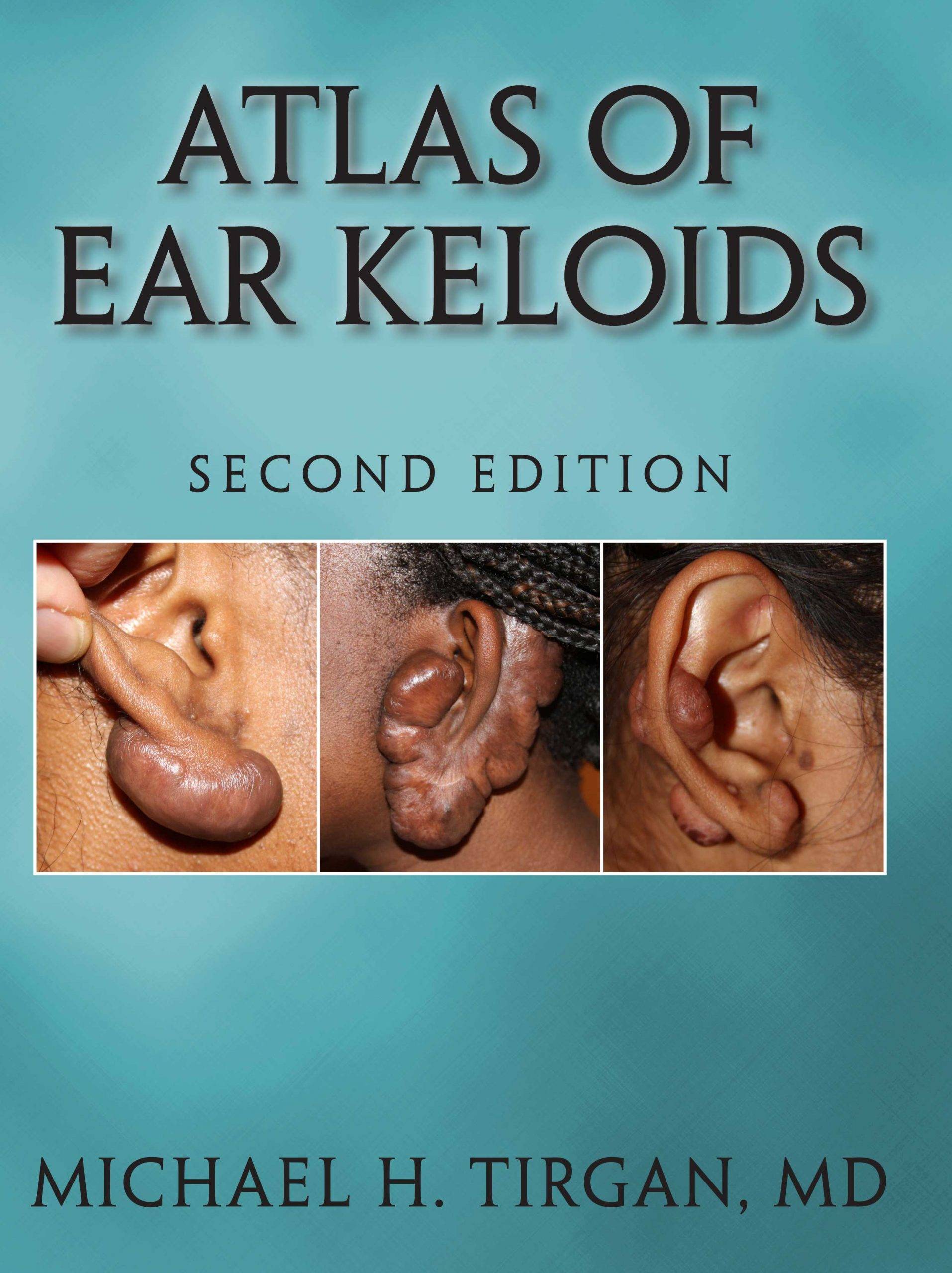 Atlas of Ear Keloids, 2nd edition by Dr. Michael Tirgan