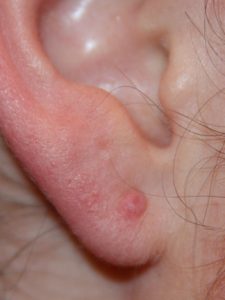 Early stage ear keloid