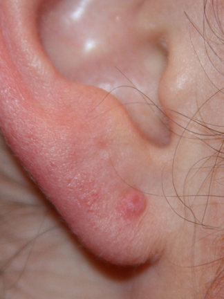 Early Stage Earlobe Keloid