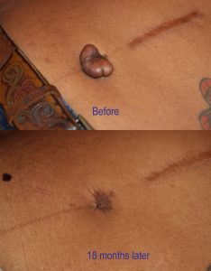 Belly Button Keloid - Treatment Results with Cryotherapy