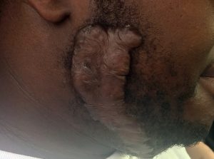 Recurrent Neck Keloid after multiple Keloid Removal Surgeries