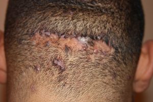 Multiple Scalp Keloids