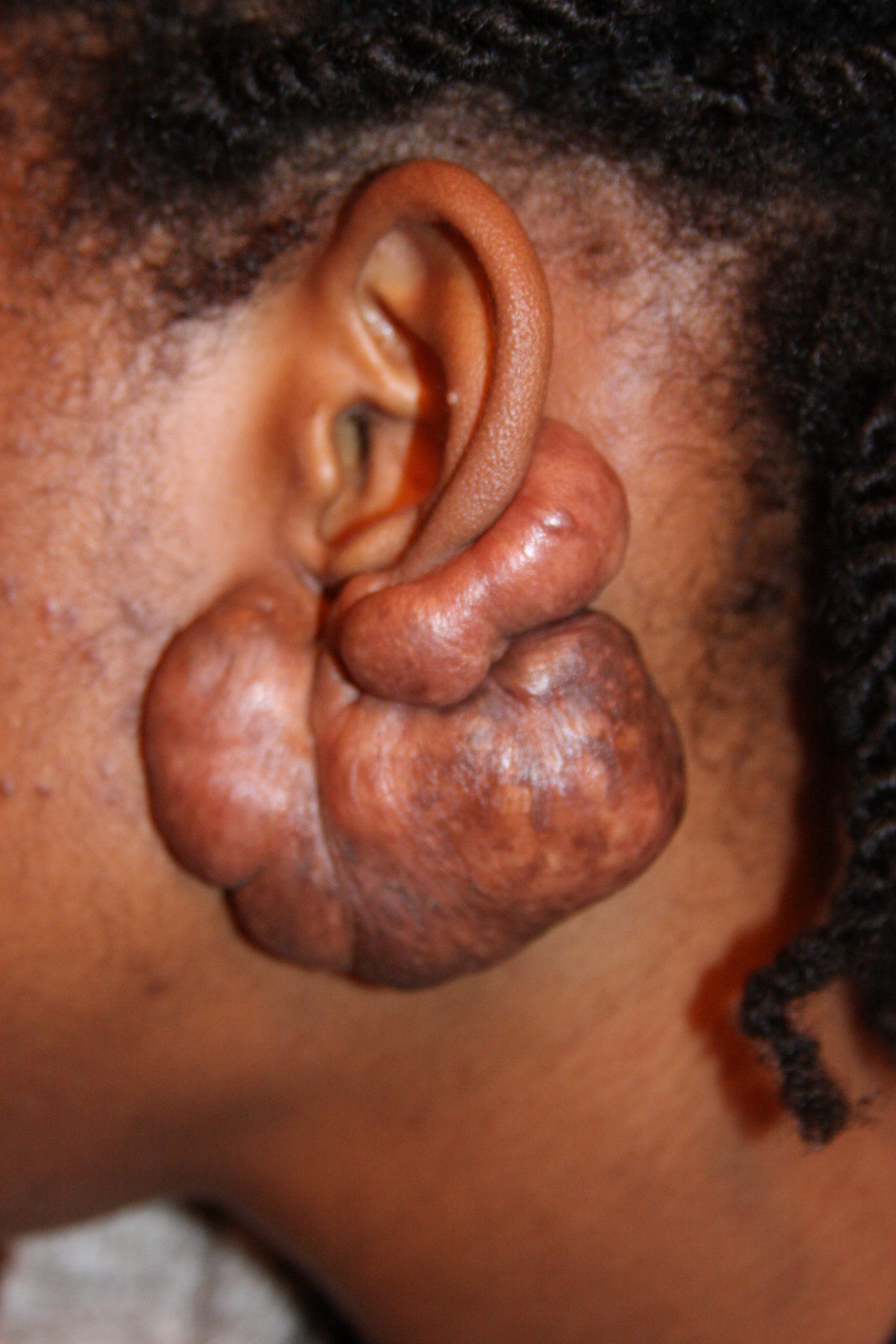 Massive Ear Keloids - Left Ear