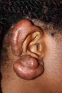 Massive Ear Keloids