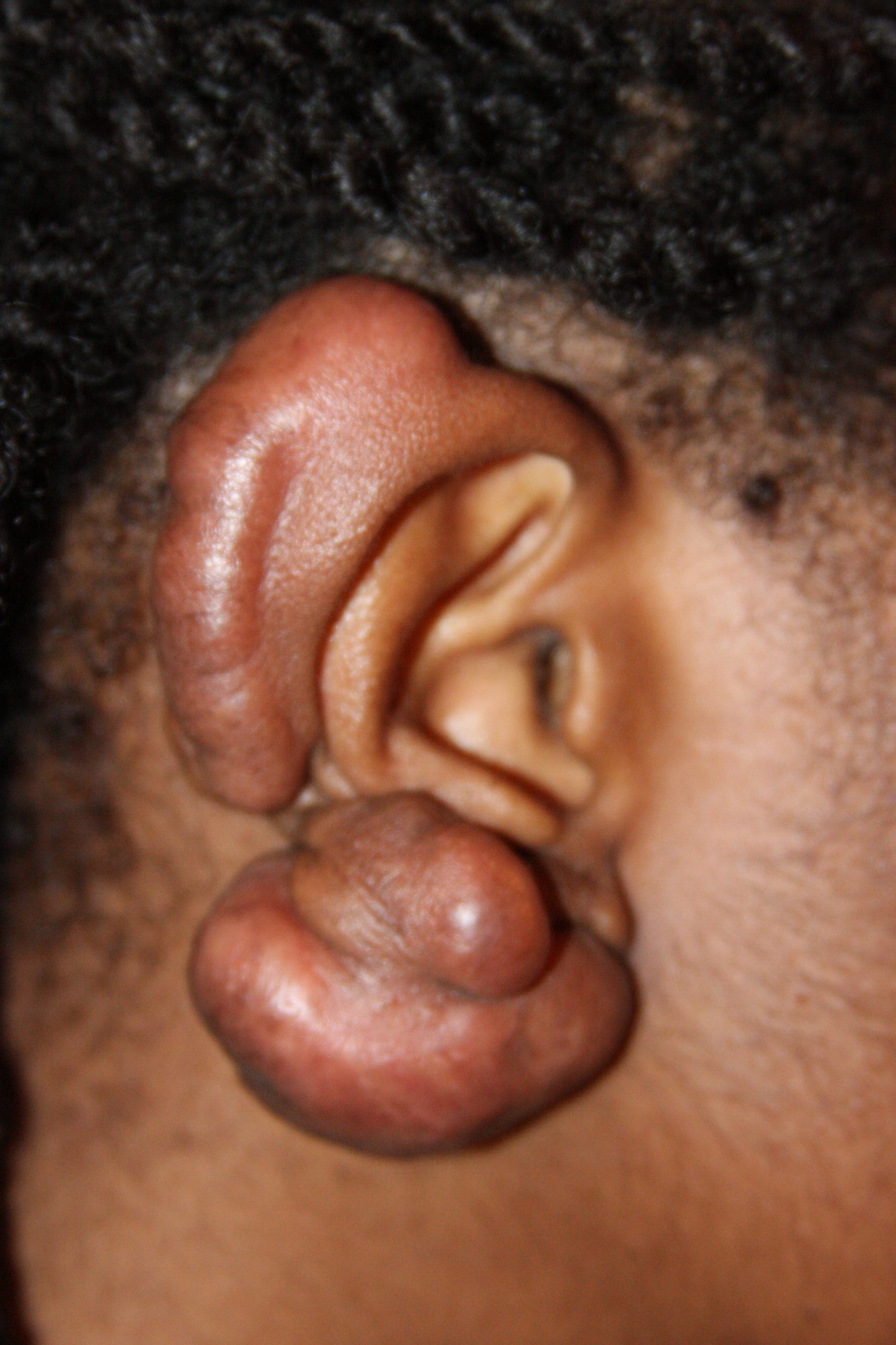 Massive Ear Keloids - Right Ear