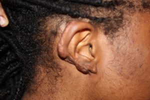 Recurrent Ear Keloids and significant loss of ear tissue after multiple Keloid Removal Surgeries