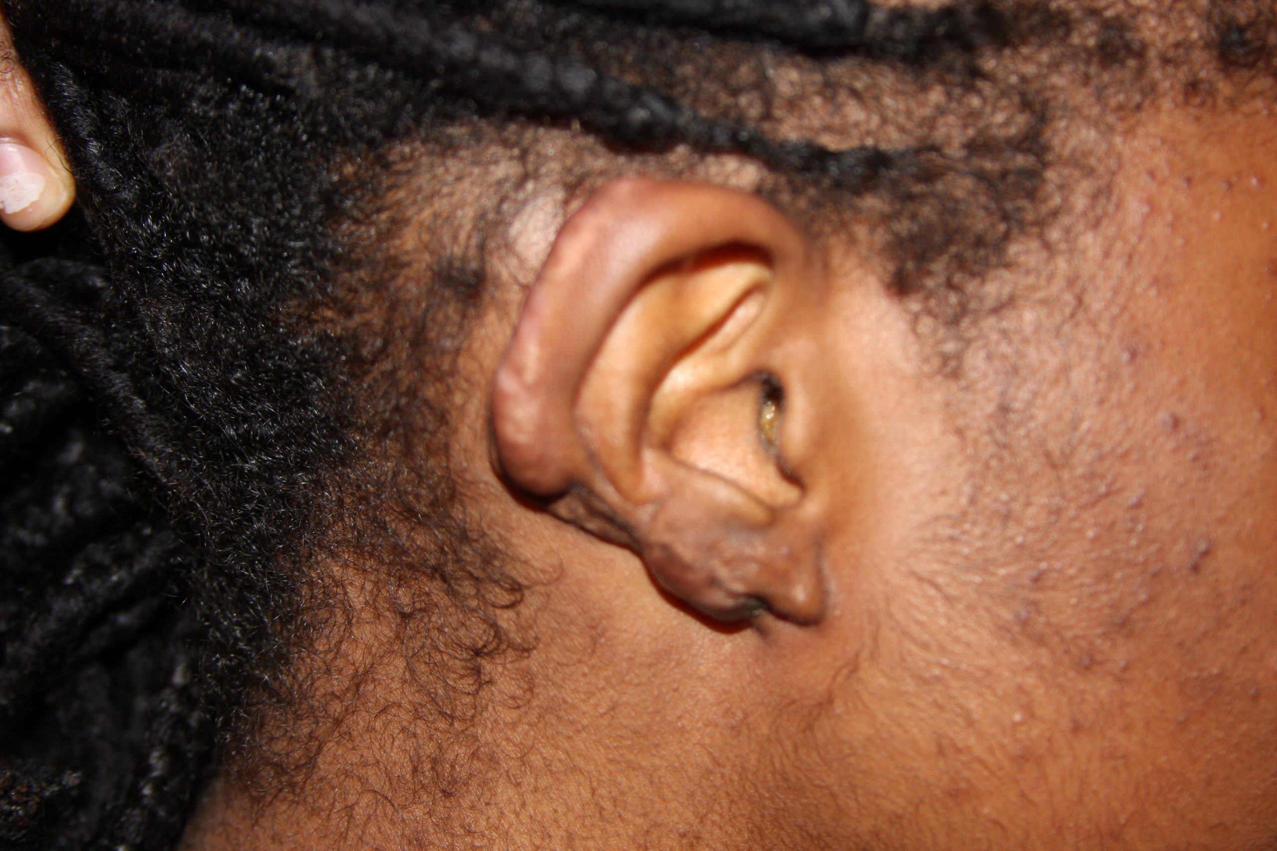 Massive Ear Keloids - Treated with Cryotherapy