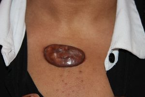 Chest Keloid - Tumoral Form