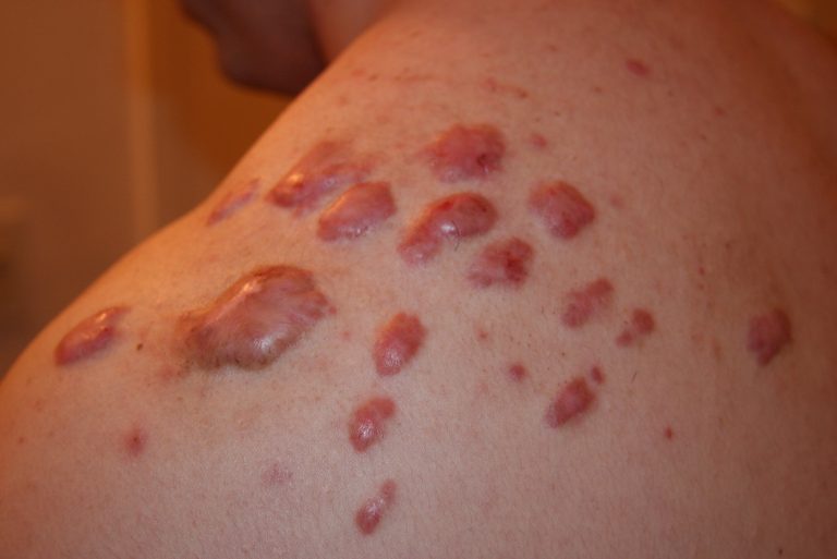 Shoulder Keloid Treated with intralesional chemotherapy