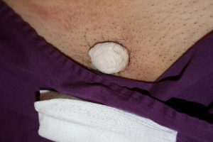 Pubic Keloid Immediately after application of cryotherapy