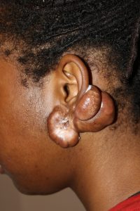 Massive Recurrent Earlobe Keloids after multiple Keloid Removal Surgeries