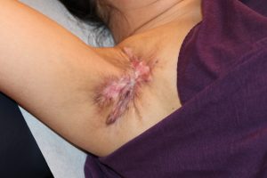 Axillary Area Keloids - Interim Results after cryotherapy