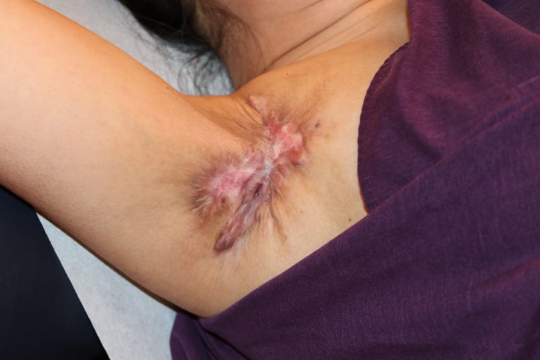 Axillary Area Keloid after debulking treatment with cryotherapy