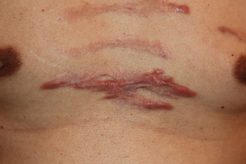 Challenging chest keloid treated with chemotherapy