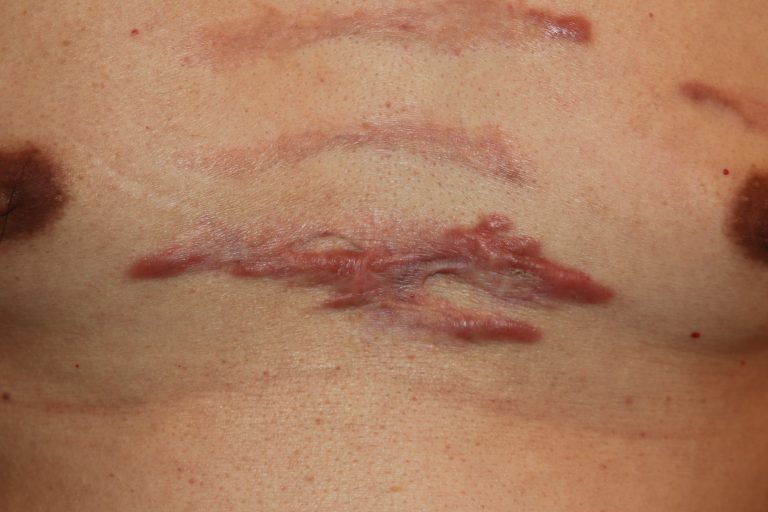 Inflammatory chest keloids