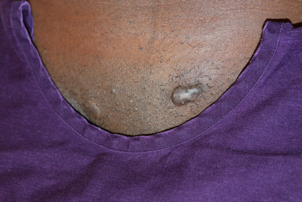 Raised pubic Keloid