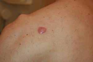 Solitary Shoulder Keloid