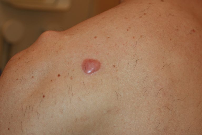 Shoulder Keloid Treated with intralesional chemotherapy