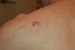 Shoulder Keloid treated with intralesional chemotherapy