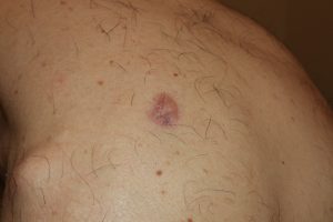 Shoulder Keloid three months after intralesional chemotherapy