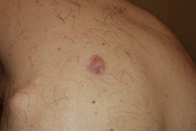 Shoulder Keloid three months after intralesional chemotherapy